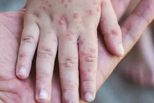 شناسایی ۶۷۴ مبتلا به «سرخک» در کشور