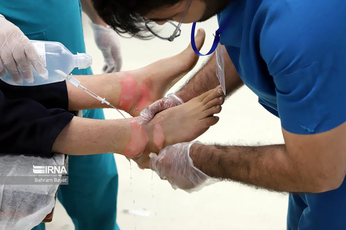 یک آمار عجیب، اما واقعی؛ سالانه ۳۰۰ هزار ایرانی می‌سوزد