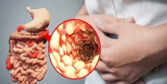علائم ابتلا به ویروس&zwnj; جدید گوارشی؛ این دارو را نخورید
